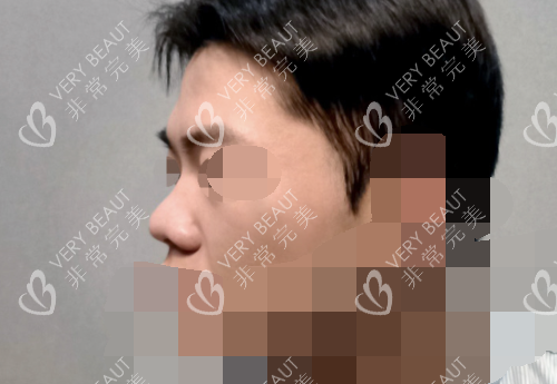 韓國優(yōu)雅人整形鼻部整形示意圖