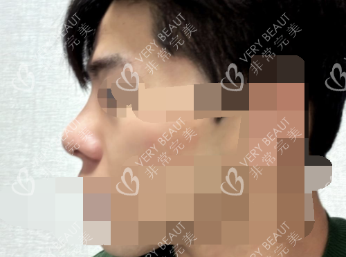 韓國優(yōu)雅人整形鼻部整形術后