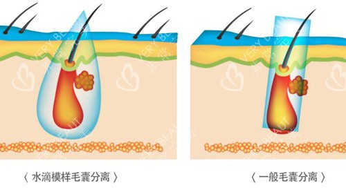 韓國(guó)多娜整形外科植發(fā)特點(diǎn)展示
