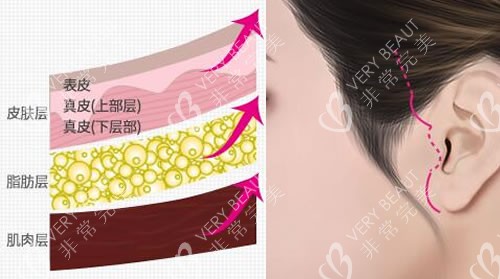 韓國秀美顏整形外科拉皮除皺特點展示