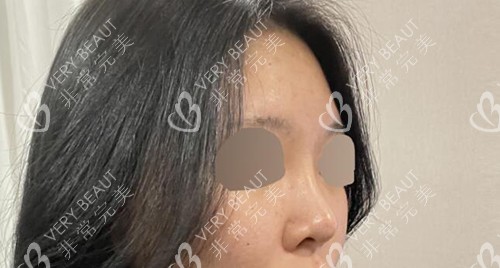 韓國(guó)愛(ài)樂(lè)整形外科隆鼻術(shù)前