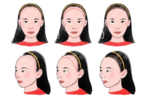 植发际线卡通图片展示