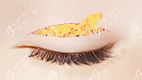 韓國CDU清潭優(yōu)整形外科雙眼皮手術(shù)特點解析