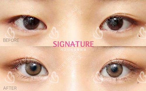 韩国Signature整形外科双眼皮