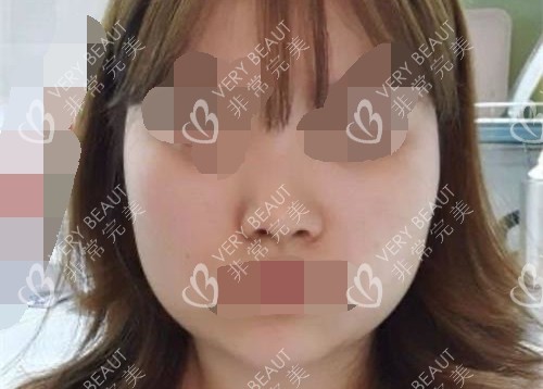 韓國(guó)伊美芝整形醫(yī)院輪廓前示意圖