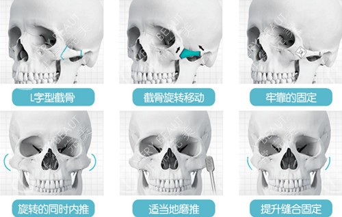 顴骨內(nèi)推手術(shù)示意圖