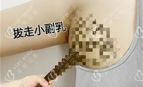 拔走副乳卡通图