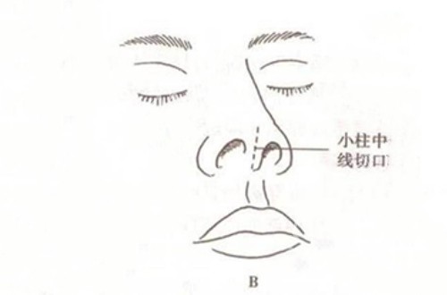 鼻小柱切口示意图