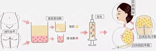 面部脂肪填充流程示意图