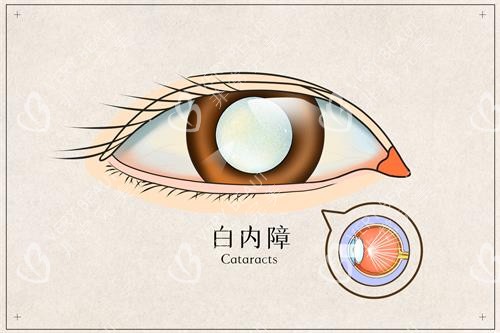 白内障手术示意图