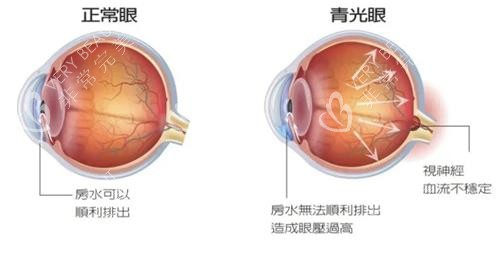 青光眼和正常眼示意图