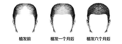 植发一个月前后示意图