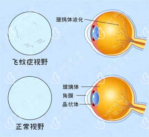 飞蚊症和正常视野示意图