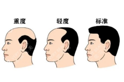 发际线标准图片展示