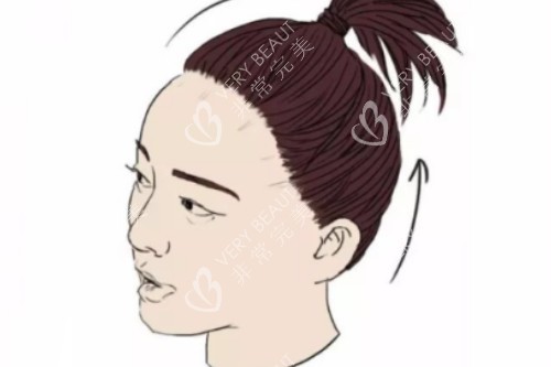 发际线后移卡通图片展示