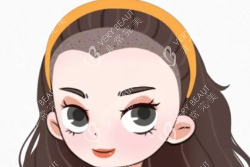 种植发际线卡通图片展示