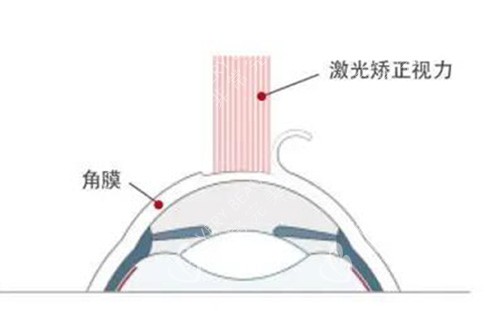 激光视力矫正改善展示