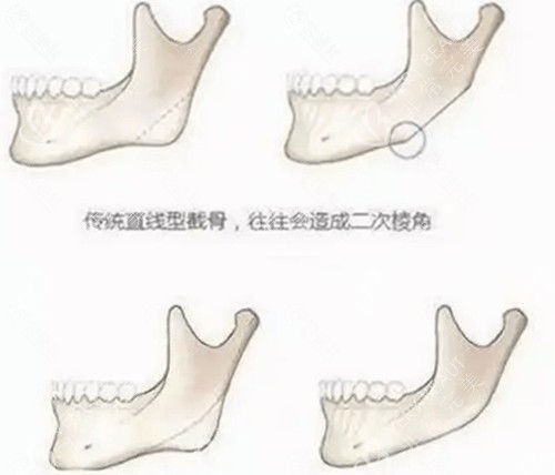 长曲线截骨的优势