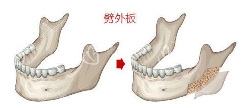 劈外板手术的变化
