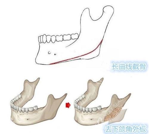 长曲线截骨和劈外板的对比