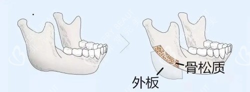 劈外板手术的示意图