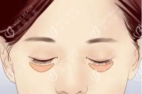 眼袋的位置图