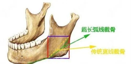 长曲线截骨的截骨位置