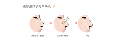 胶原蛋白填充过程