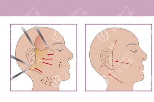 拉皮手术过程2