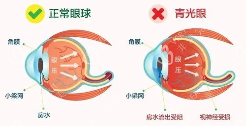 青光眼眼球示意图