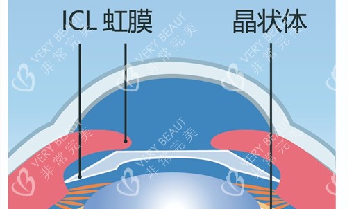 晶体植入位置示意图