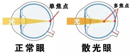 正常眼和散光眼的焦点