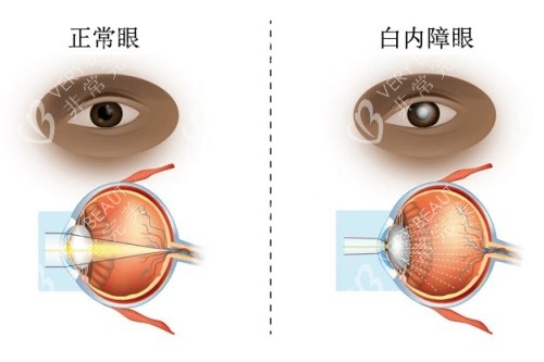 正常眼和白内障眼卡通图片展示