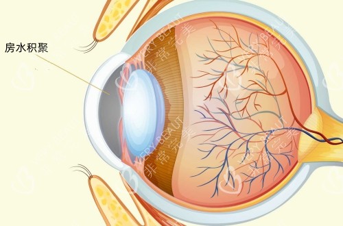 青光眼房水会积聚