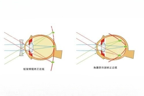 配戴眼镜和佩戴角膜塑形镜概念图