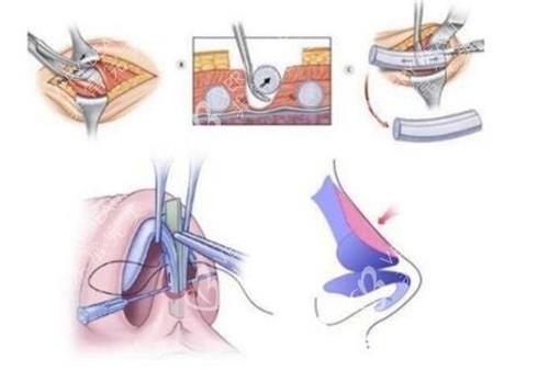 隆鼻手术过程
