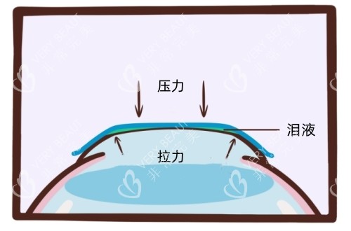 角膜塑形镜的原理示意图