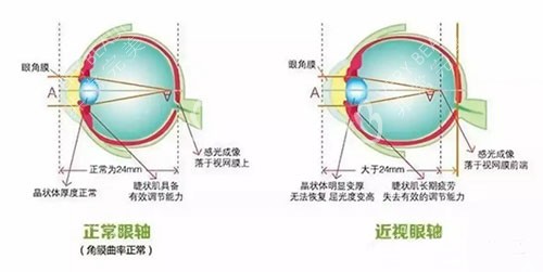 正常眼睛和近视眼的区别