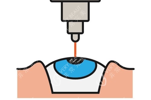 近视矫正激光手术卡通示意图
