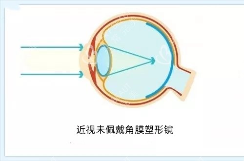 孩子近视时的成像示意图