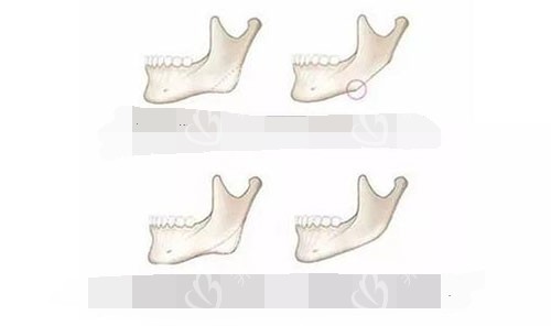 下颌角手术示意图