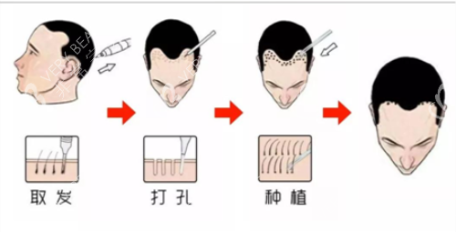 种植发的手术过程
