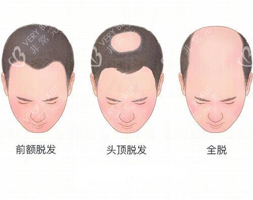 不同种类脱发的示意图