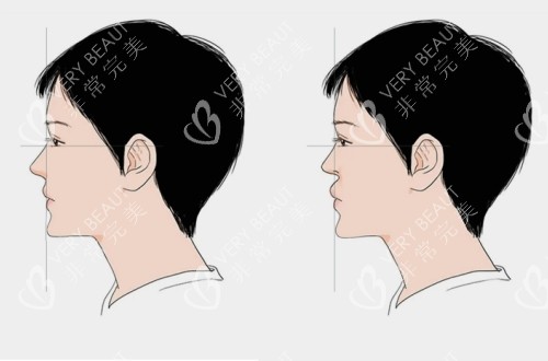 正常鼻基底和鼻基底凹陷对比图