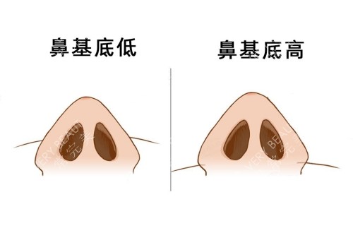 鼻基底高低对鼻子高低的影响示意图