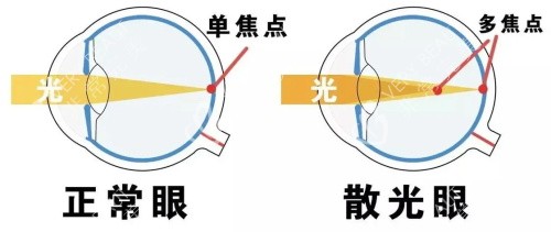 正常眼睛與散光眼睛的焦點(diǎn)不同