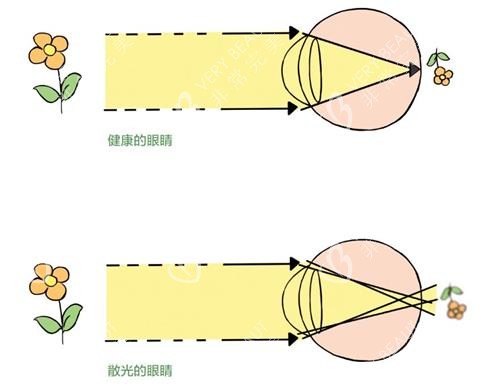 正常眼睛與散光看東西的區(qū)別