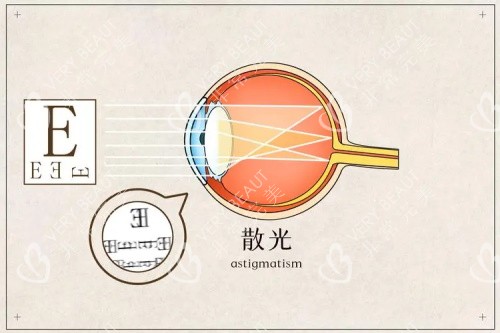 散光的示意圖