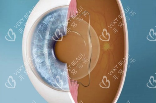 ICL晶体在眼球具体位置的侧面解剖图