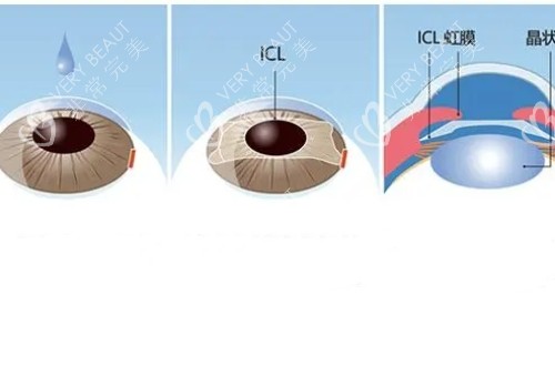ICL晶体植入眼睛里的过程示意图
